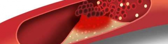 cholesterol Cholesterol